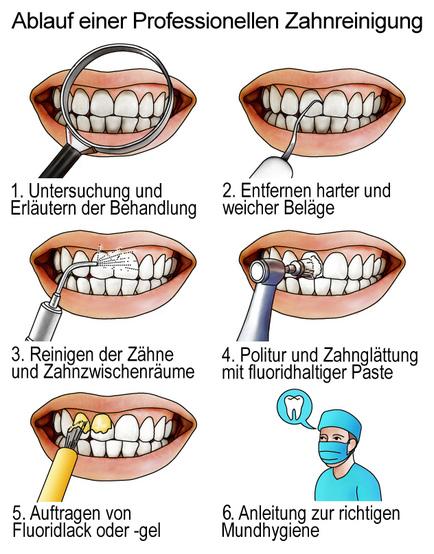 Ablauf einer Professionellen Zahnreinigung in 6 Schritten